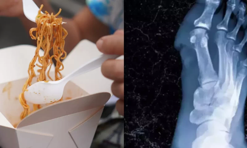 Student Undergoes Limb Amputation After Eating Roommate's Leftover Noodles